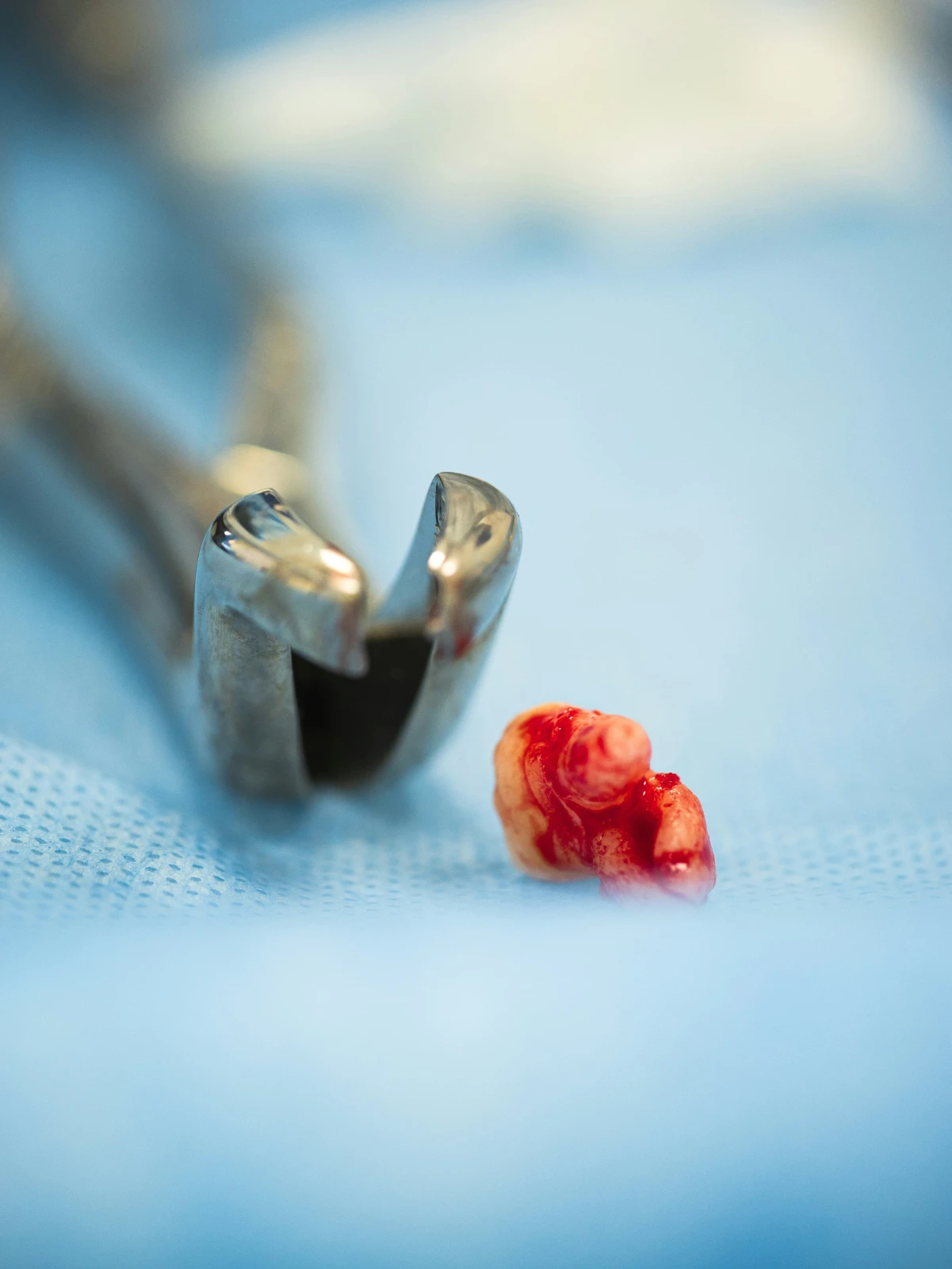 Tooth Extraction — Oral Surgery & Root Canal Care