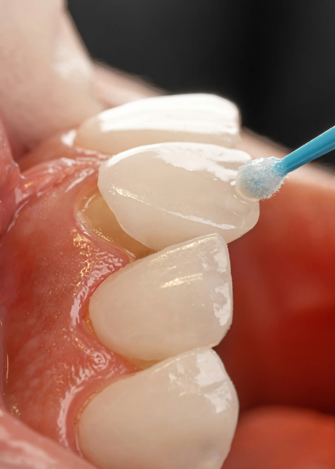 Sealants & Fluoride Application — Preventive Care