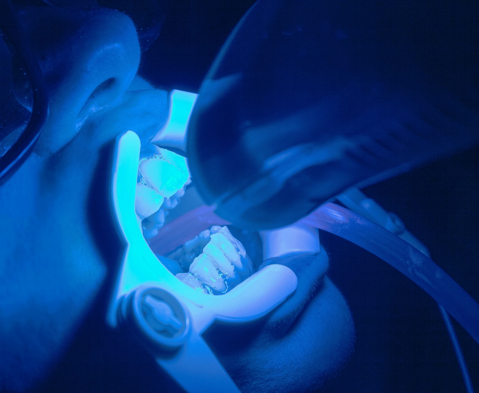 Teeth Whitening — Cosmetic Dentistry