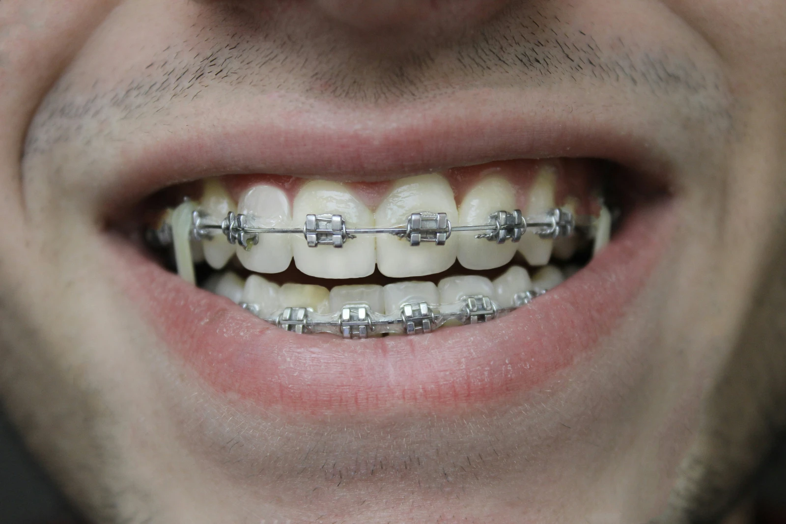 Orthodontic Braces — Orthodontics