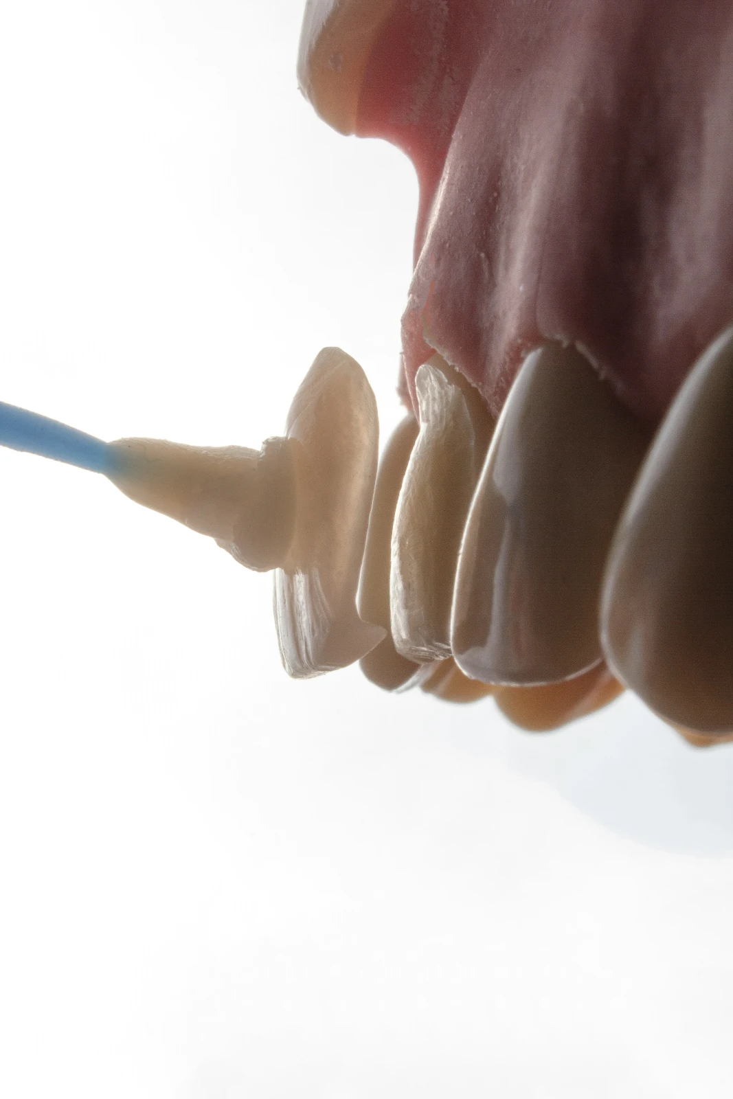 Dental Veneers — Cosmetic Dentistry
