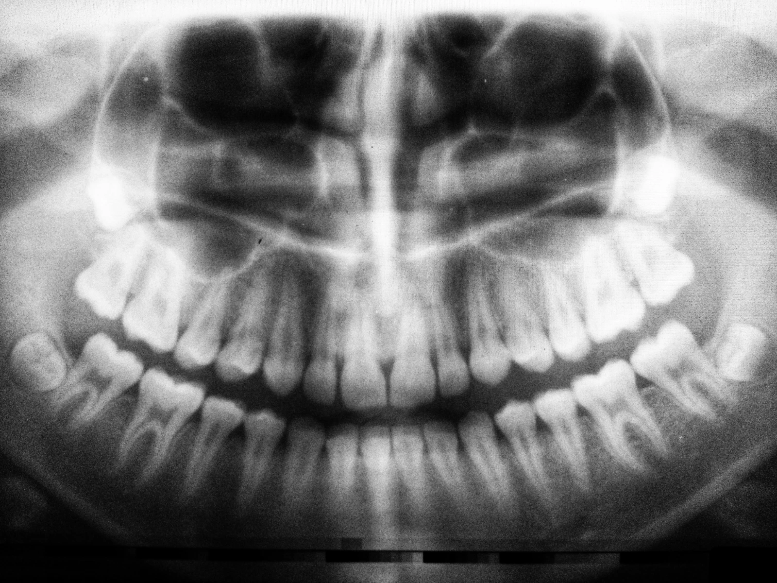 Dental X-rays — Preventive Care